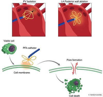 The promise of pulsed field ablation and the challenges ahead